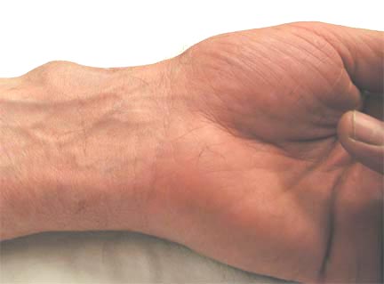 WristGanglion1a.jpg